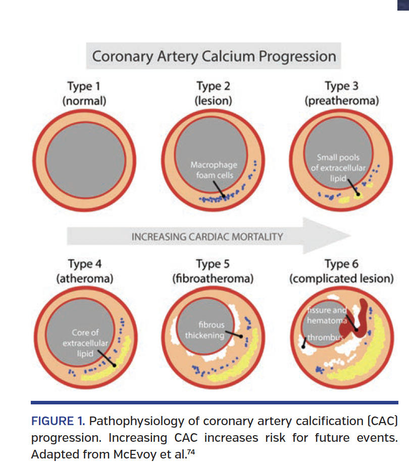 The Impact and Pathophysiologic Consequences of Coronary Artery Calcium